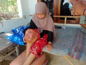 Mahasiswi IAIN Madura menderita penyakit tumor ganas